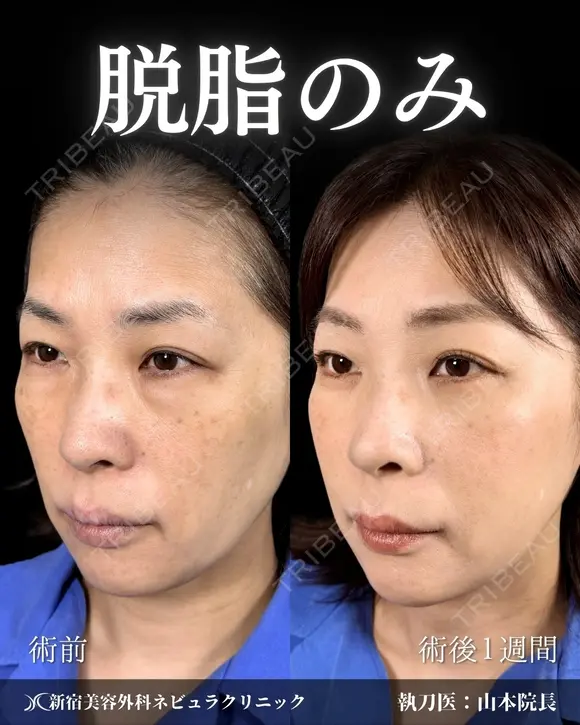 山本の🎀クマ取り🎀 before画像 メイン用