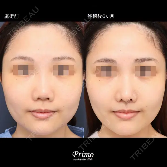 MU 鼻中隔延長術修正術（肋軟骨）＋他院鼻プロテーゼ入れ替え術＋眉間プロテーゼ（特別注文プロテーゼ） before画像 メイン用