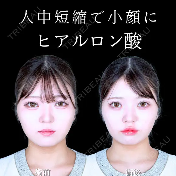 唇ヒアルロン酸 0日後 メイン用