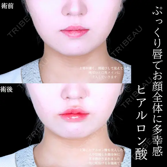 唇ヒアルロン酸 before画像 メイン用