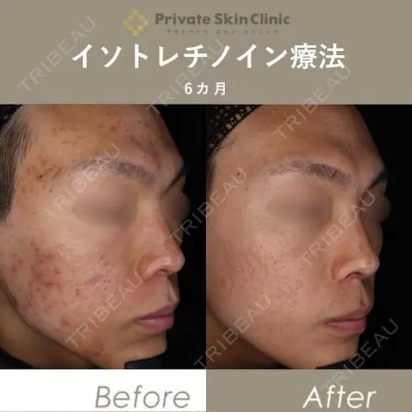 【井畑Dr】イソトレチノイン療法 after画像 メイン用
