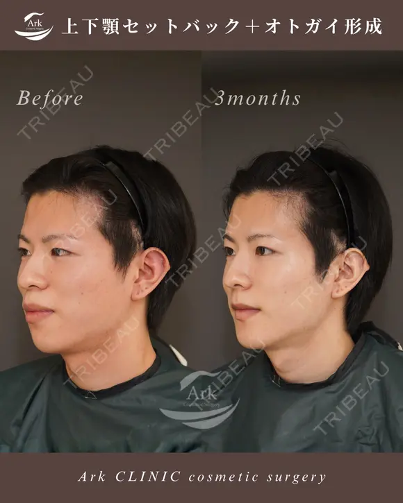 上下セットバック＋オトガイ形成 before画像 メイン用