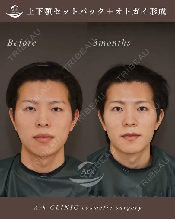 上下セットバック＋オトガイ形成 after画像 メイン用