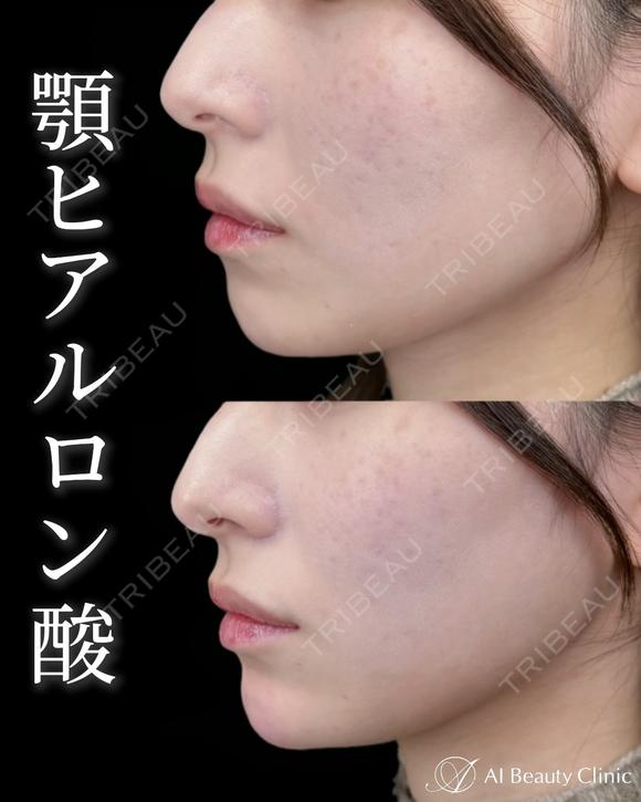 顎ヒアルロン酸 after画像 メイン用