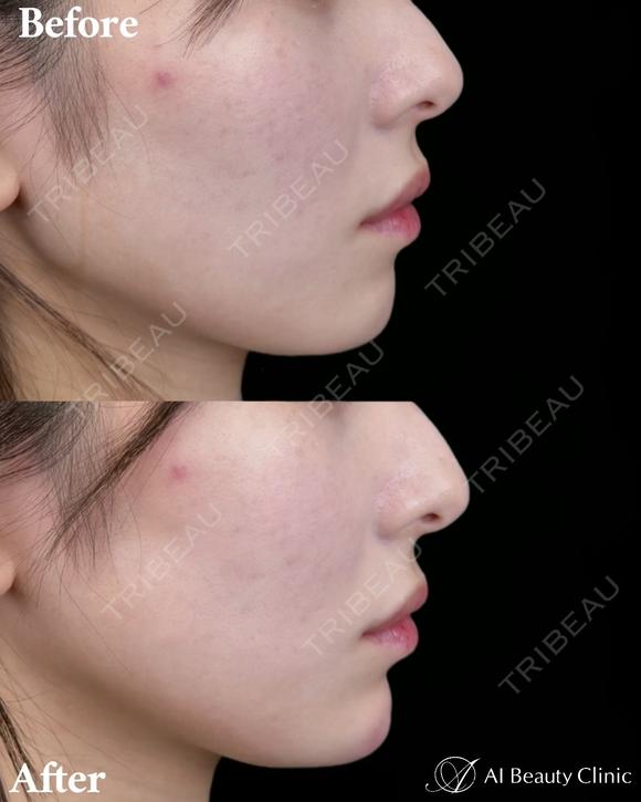 顎ヒアルロン酸 before画像 メイン用