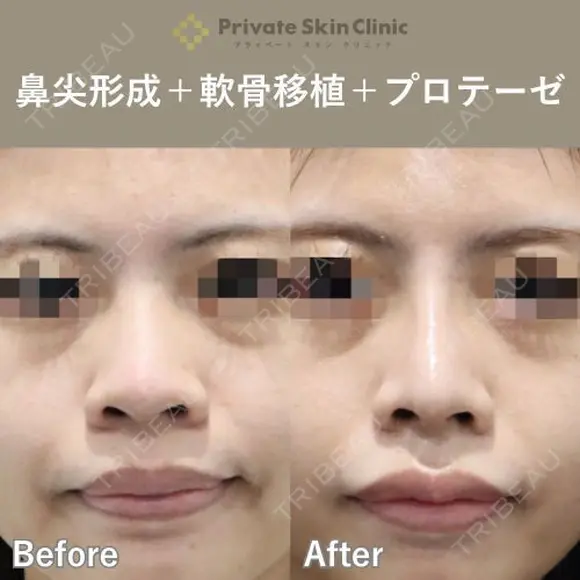 【安形Dr】耳介軟骨移植（鼻）・鼻尖形成術鼻・プロテーゼ(隆鼻術) before画像 メイン用