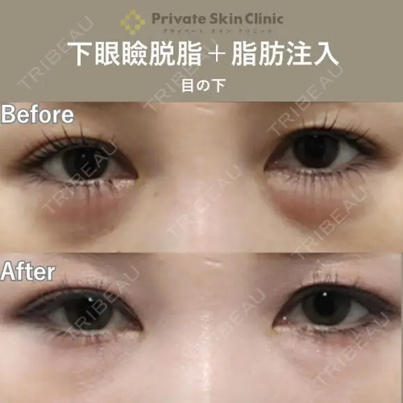 【安形Dr】下眼瞼脱脂＋脂肪注入（目の下） before画像 メイン用