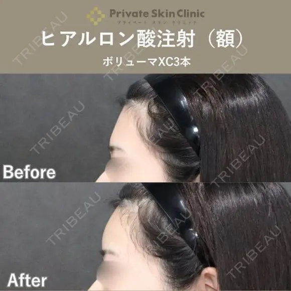 【井畑Dr】ヒアルロン酸注射（額） after画像 メイン用