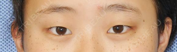 ナチュラル二重埋没法 before画像 メイン用