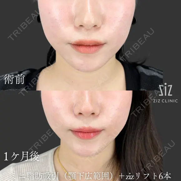 【ミニ脂肪吸引】プレ花嫁ダウンタイム間に合う？ before画像 メイン用
