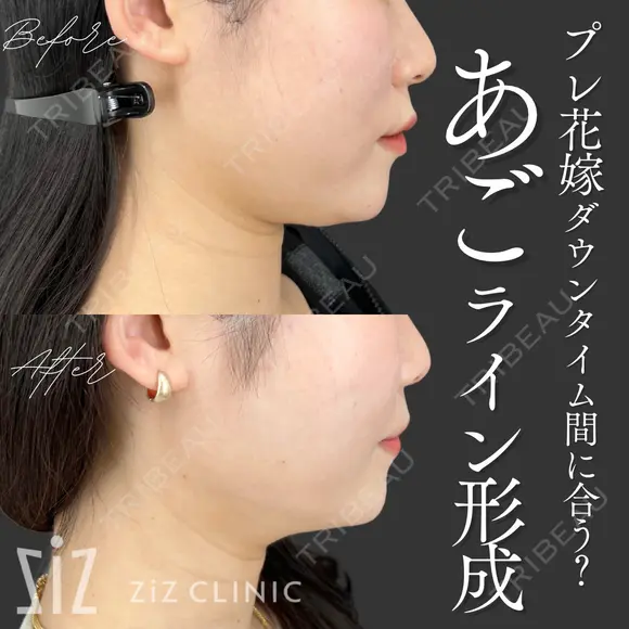 【ミニ脂肪吸引】プレ花嫁ダウンタイム間に合う？ after画像 メイン用