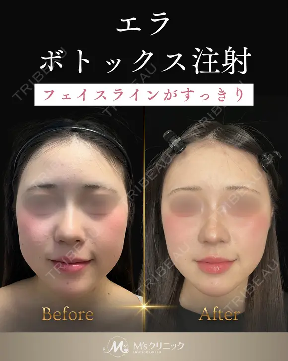 エラボトックスでスッキリ小顔に✨フェイスラインがシャープに before画像 メイン用