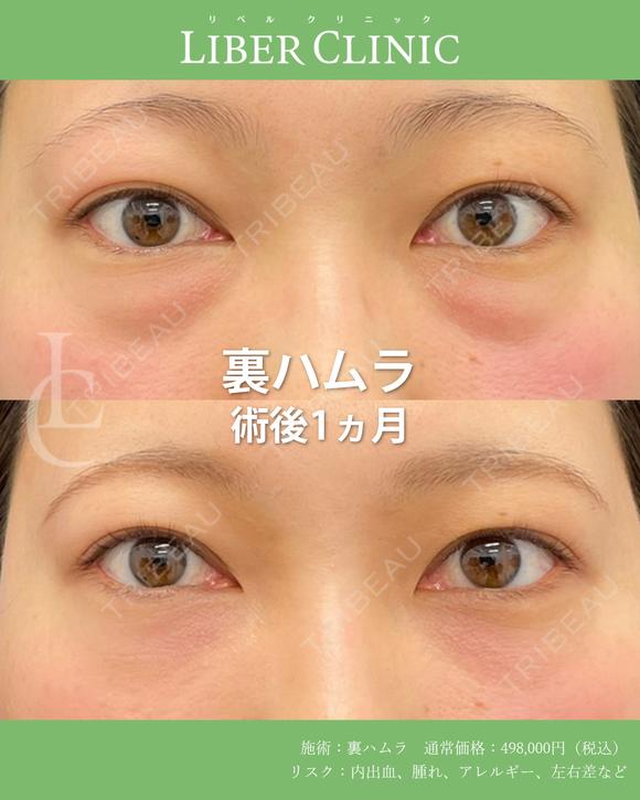 "化粧で隠せない 凹凸に裏ハムラ" 30日後 メイン用