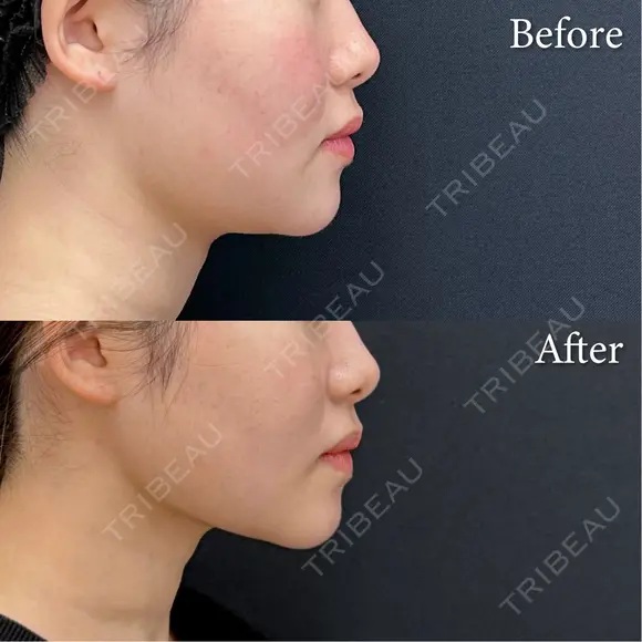 脂肪吸引注射 after画像 メイン用