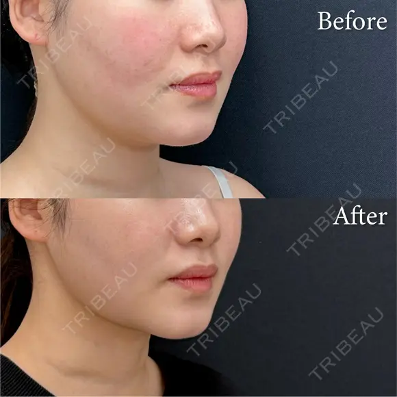 脂肪吸引注射 after画像 メイン用