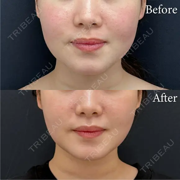 脂肪吸引注射 after画像 メイン用