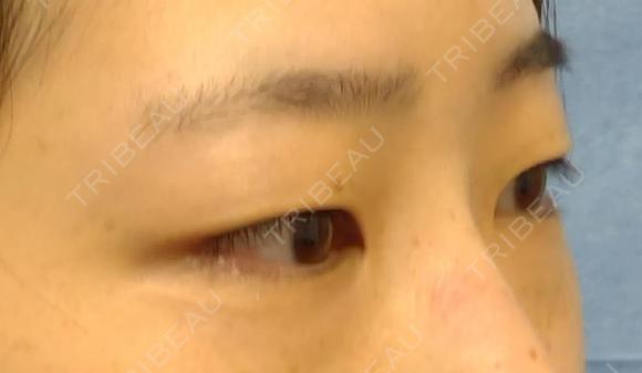 ナチュラル埋没法 before画像 メイン用