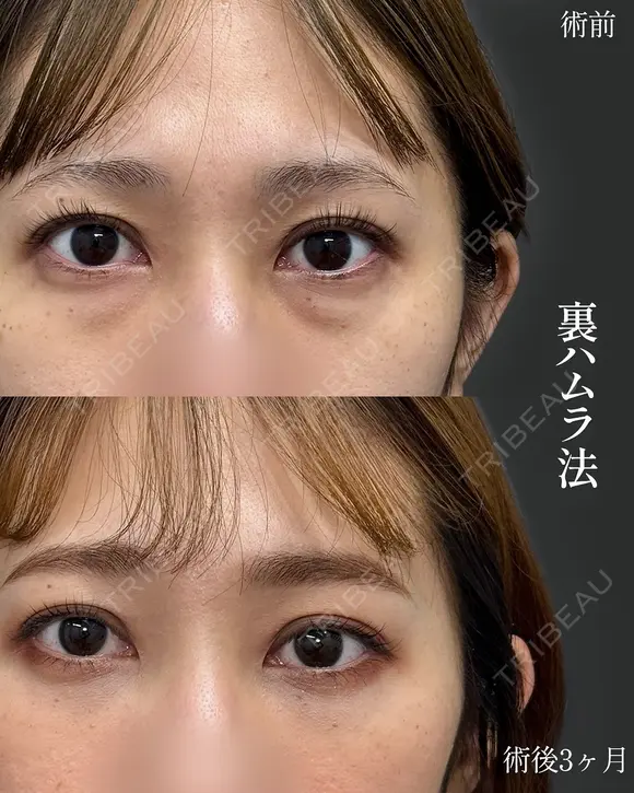 目元の症例集（クマ治療・目元拡大術） before画像 メイン用