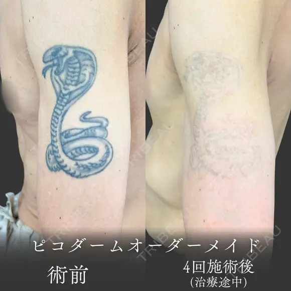 【タトゥー除去】左腕のコブラ before画像 メイン用