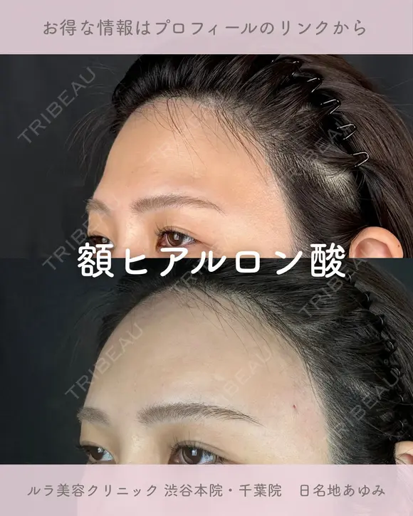 額ヒアルロン酸 before画像 メイン用