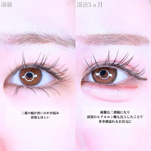 アリエルクイックループトリプル二重埋没法/涙袋ヒアルロン酸 before画像 メイン用