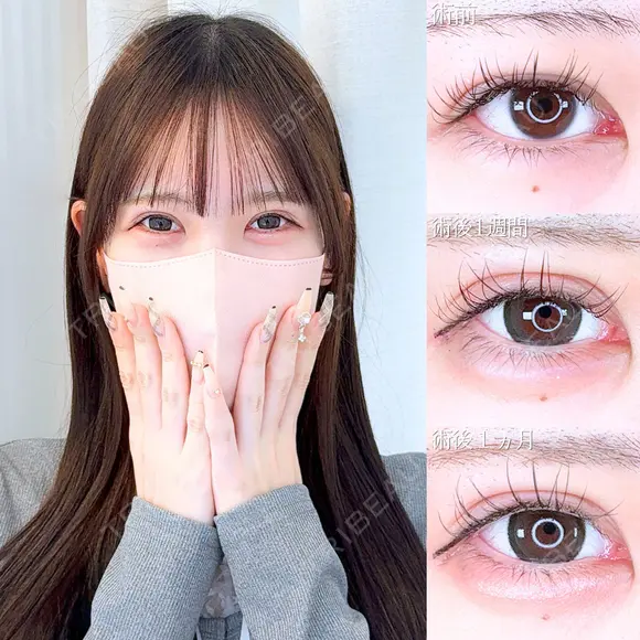 アリエルクイックループダブル二重埋没法/瞼の上の脂肪取り/涙袋ヒアルロン酸 after画像 メイン用