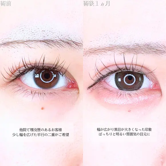 アリエルクイックループダブル二重埋没法/瞼の上の脂肪取り/涙袋ヒアルロン酸 before画像 メイン用