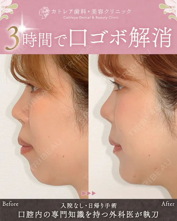 出っ歯🐰口元の膨らみ🎈上下セットバック 90日後 メイン用