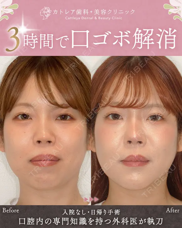 出っ歯🐰口元の膨らみ🎈上下セットバック 90日後 メイン用