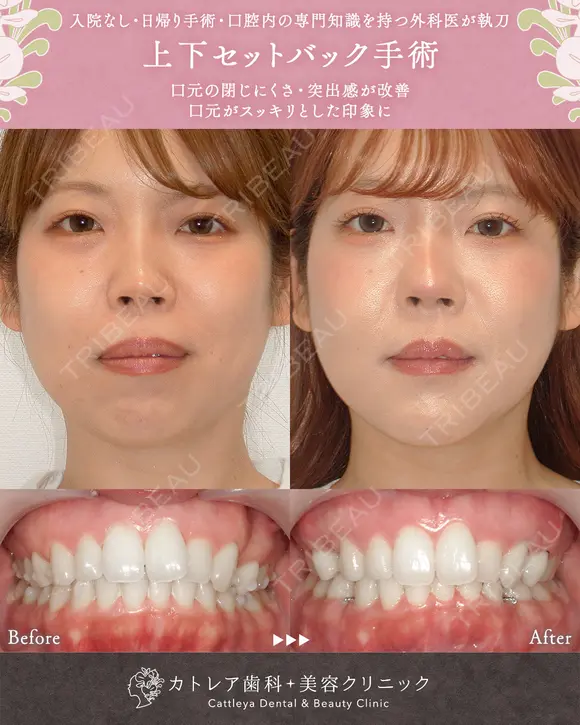 出っ歯🐰口元の膨らみ🎈上下セットバック 90日後 メイン用