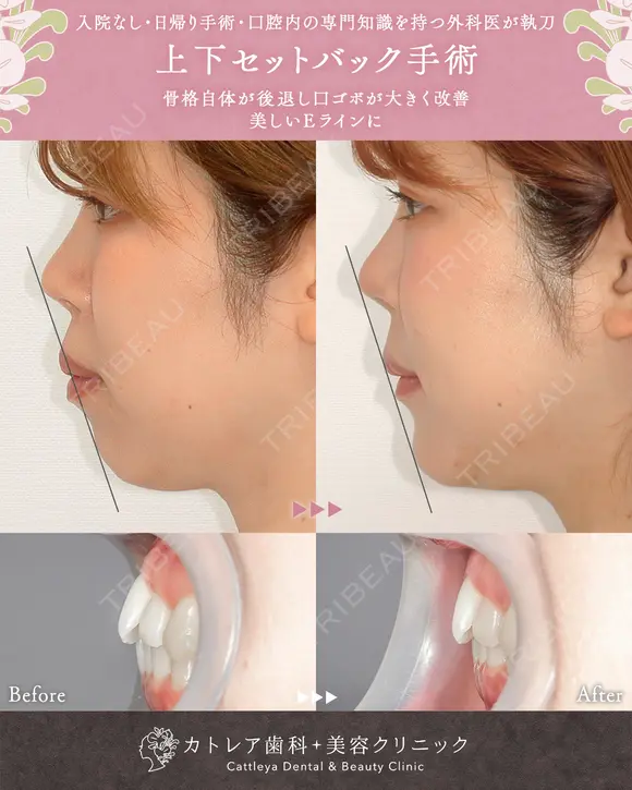 出っ歯🐰口元の膨らみ🎈上下セットバック 90日後 メイン用