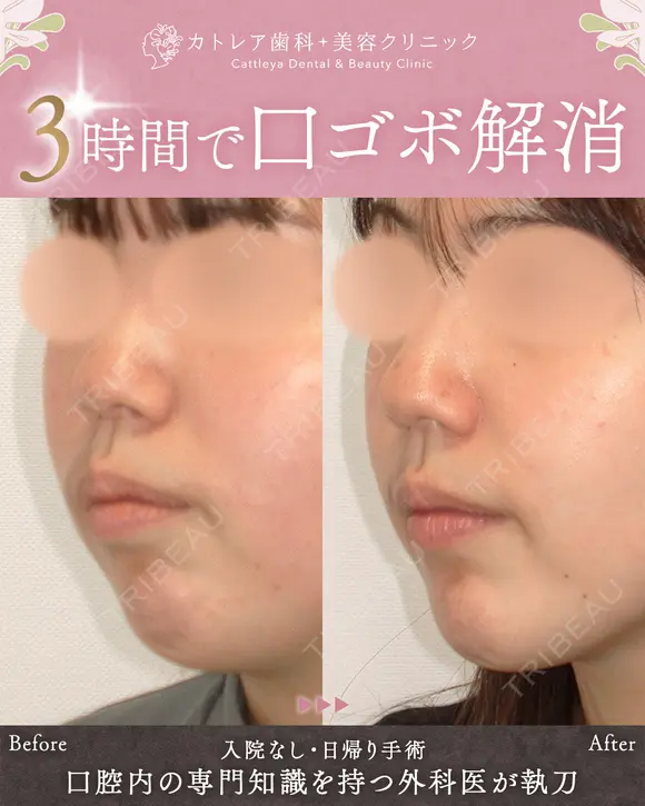 出っ歯🐰口元の膨らみ🎈上下セットバック 180日後 メイン用