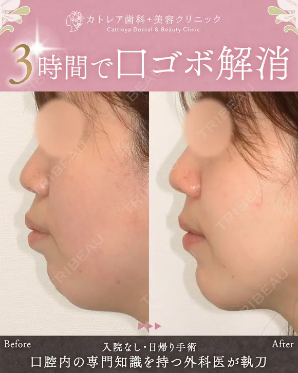 出っ歯🐰口元の膨らみ🎈上下セットバック 180日後 メイン用
