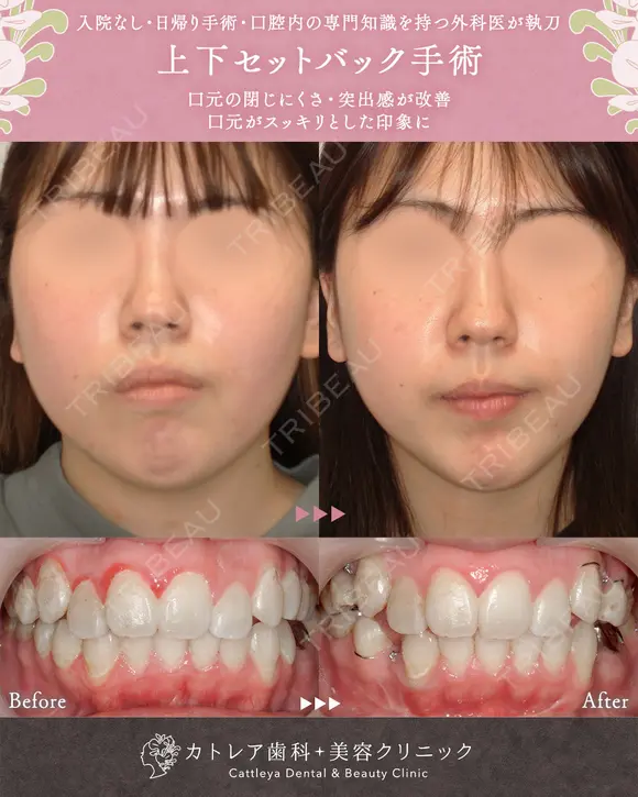 出っ歯🐰口元の膨らみ🎈上下セットバック 180日後 メイン用