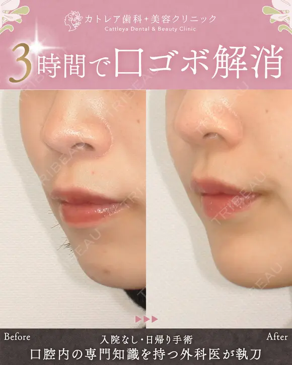 出っ歯🐰口元の膨らみ🎈上下セットバック 180日後 メイン用