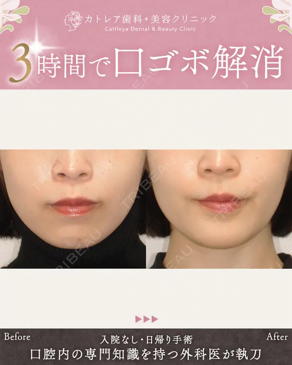 出っ歯🐰口元の膨らみ🎈上下セットバック 180日後 メイン用
