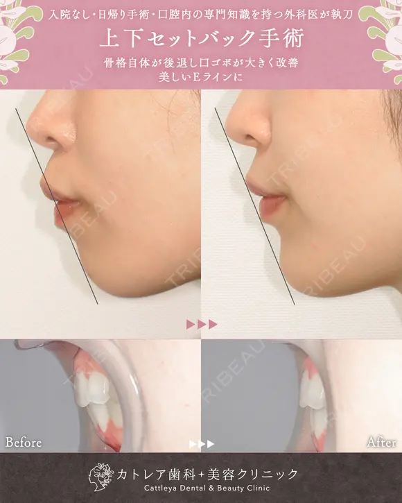 出っ歯🐰口元の膨らみ🎈上下セットバック 180日後 メイン用