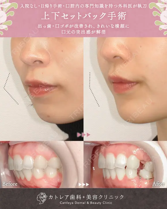 出っ歯🐰口元の膨らみ🎈上下セットバック 180日後 メイン用
