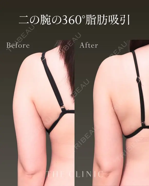 理想のストレート二の腕に｜二の腕の360°脂肪吸引 before画像 メイン用