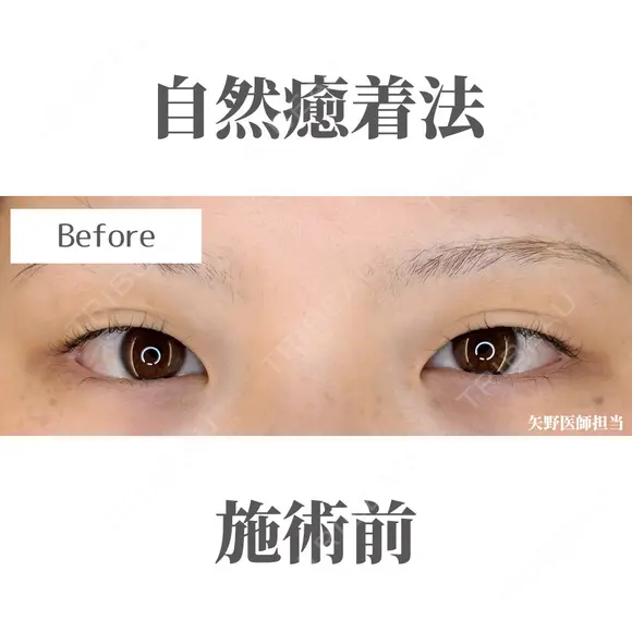自然癒着法 before画像 メイン用
