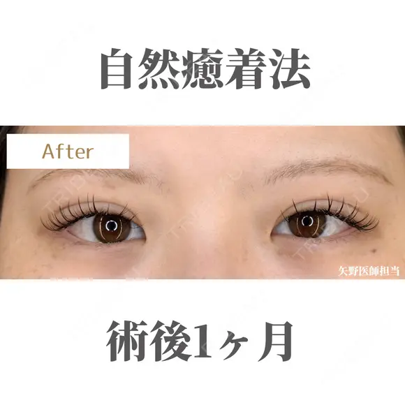 自然癒着法 after画像 メイン用
