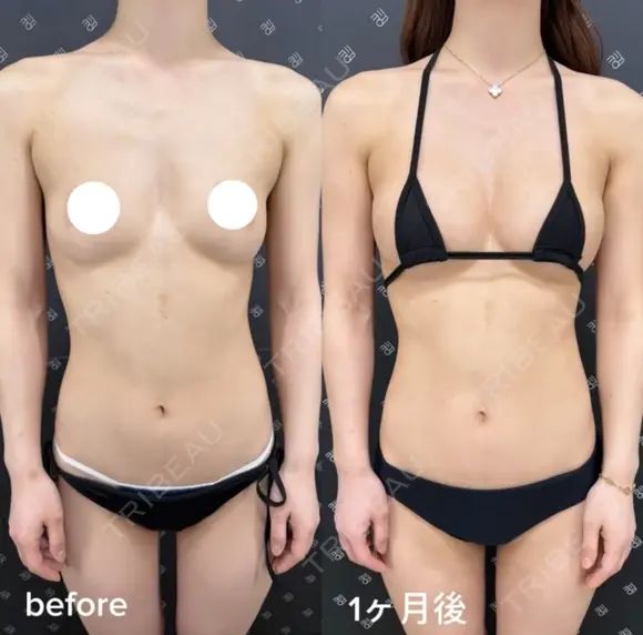 二の腕脂肪吸引＋脂肪豊胸 after画像 メイン用