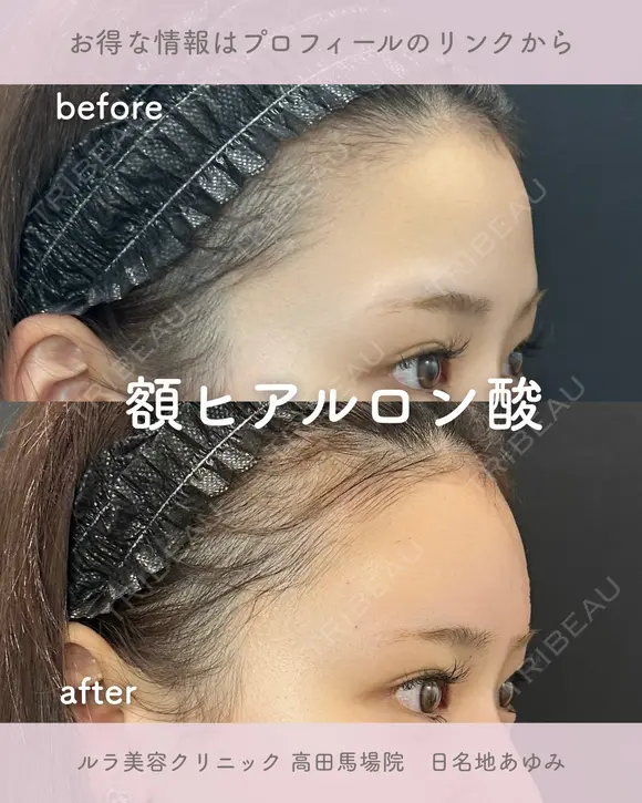 額ヒアルロン酸 before画像 メイン用