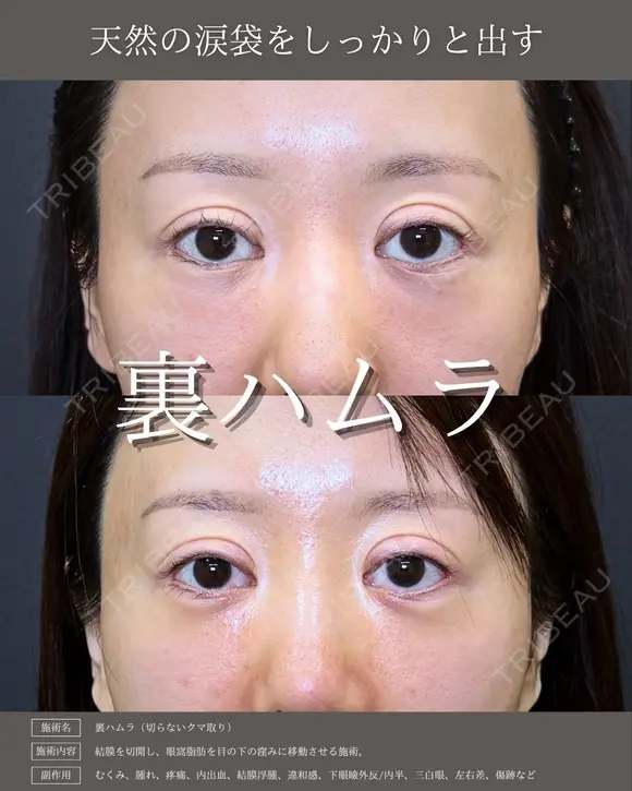 【クマ治療】裏ハムラ法 before画像 メイン用
