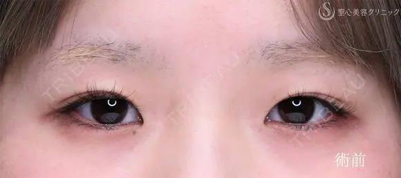 【10代女性・埋没法でナチュラル二重に】 二重術（埋没法）：マイクロメソッド+α（1ヶ月後） before画像 メイン用