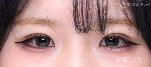 【10代女性・埋没法でナチュラル二重に】 二重術（埋没法）：マイクロメソッド+α（1ヶ月後） 30日後 メイン用