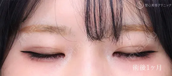 【10代女性・埋没法でナチュラル二重に】 二重術（埋没法）：マイクロメソッド+α（1ヶ月後） 30日後 メイン用