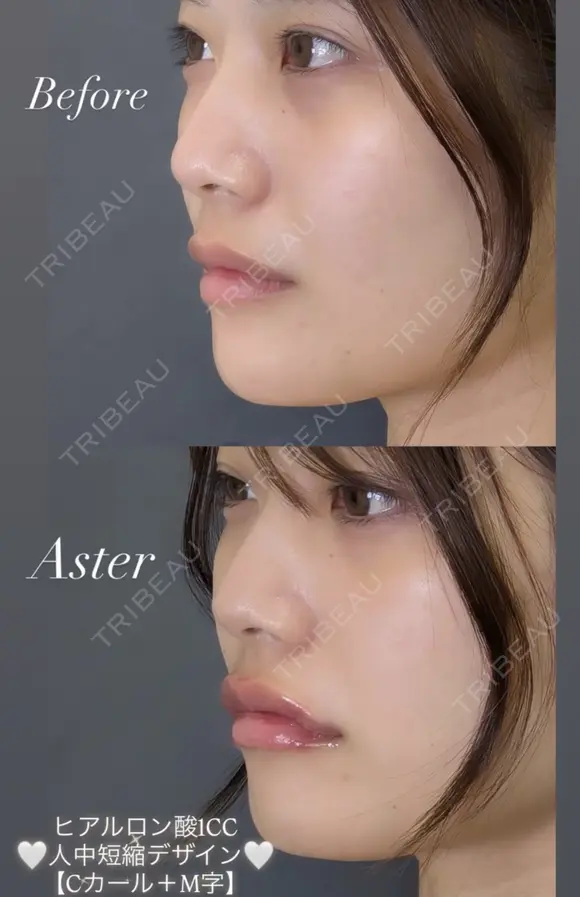 【リップ】ヒアルロン酸注入 before画像 メイン用