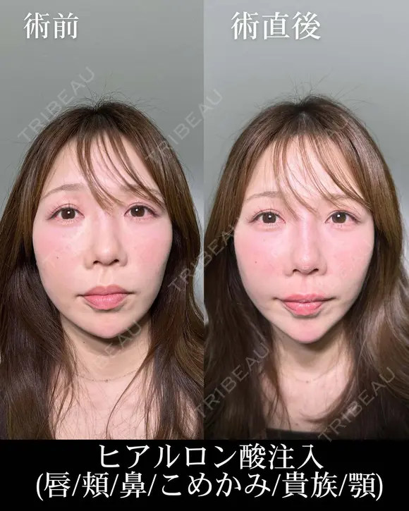 ヒアルロン酸注入（唇/頬/鼻/こめかみ/貴族/顎） after画像 メイン用