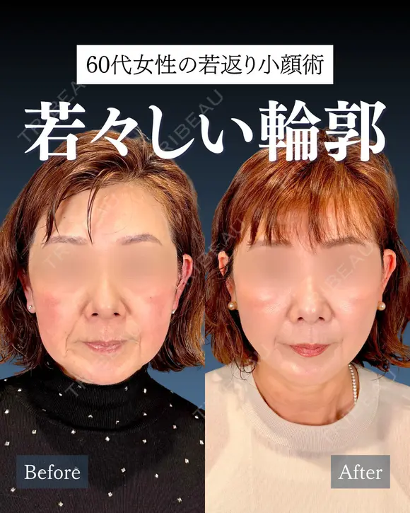 岩﨑先生による🔥小顔整形🔥 after画像 メイン用